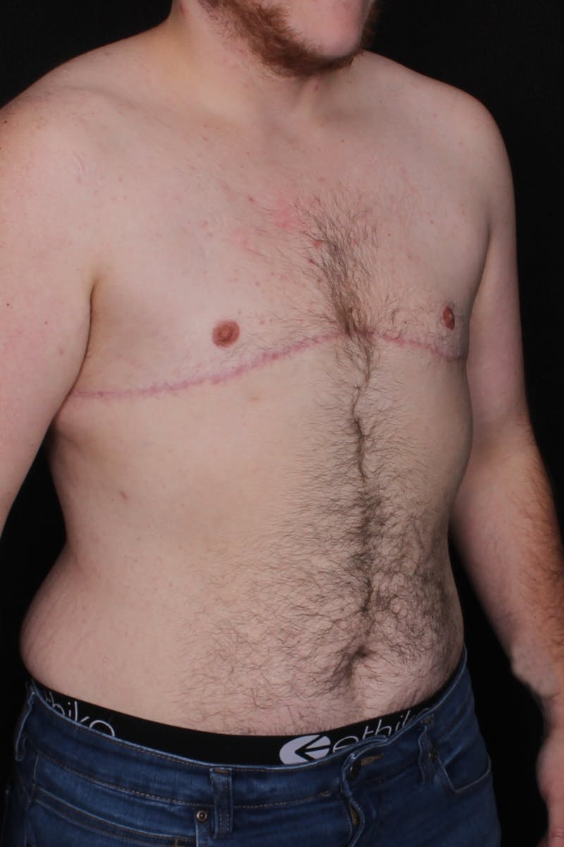 FTM Top Surgery Before & After Gallery - Patient 297266 - Image 4