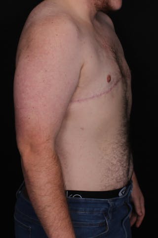FTM Top Surgery Before & After Gallery - Patient 297266 - Image 6