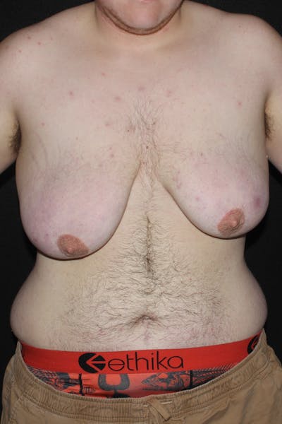 FTM Top Surgery Before & After Gallery - Patient 297266 - Image 1