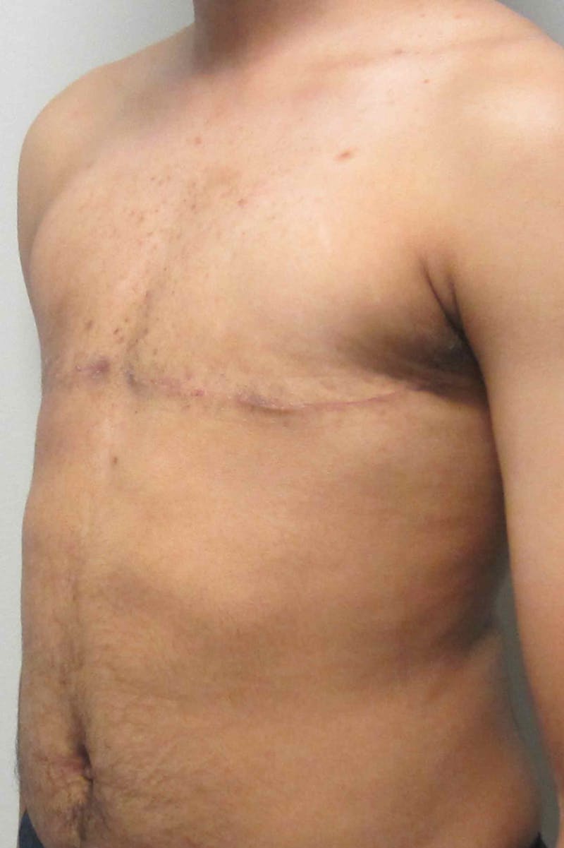 FTM Top Surgery Before & After Gallery - Patient 169056 - Image 4
