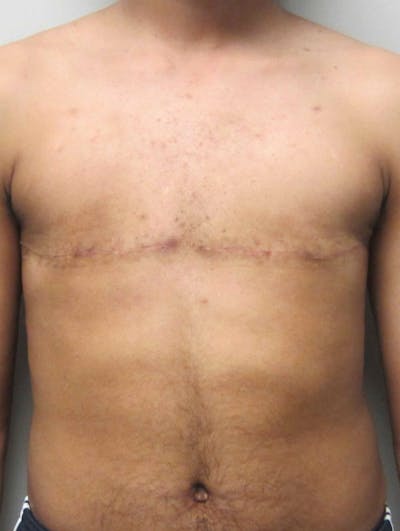 FTM Top Surgery Before & After Gallery - Patient 169056 - Image 2