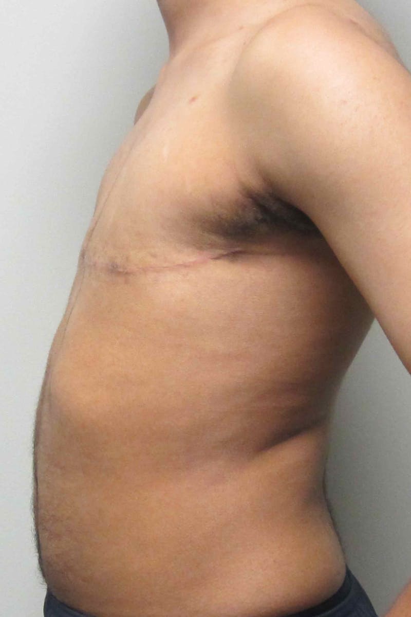 FTM Top Surgery Before & After Gallery - Patient 169056 - Image 6