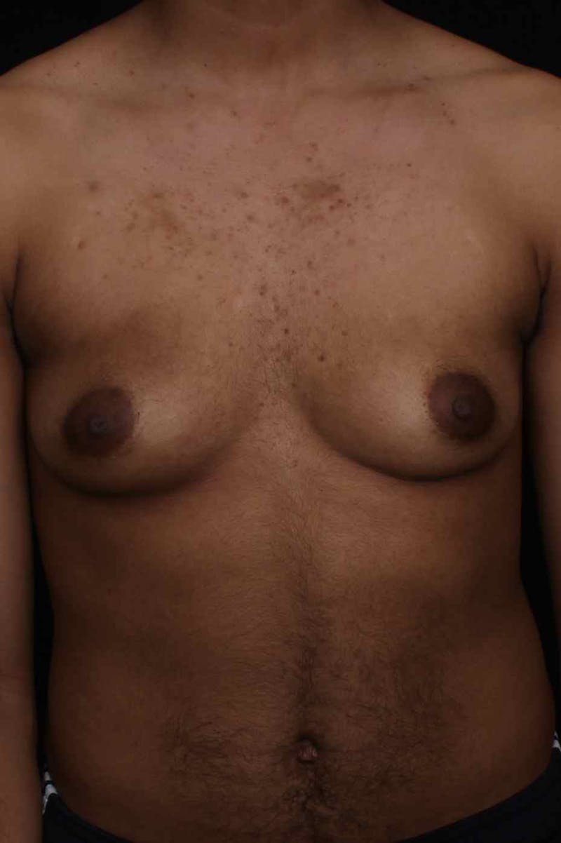 FTM Top Surgery Before & After Gallery - Patient 169056 - Image 1