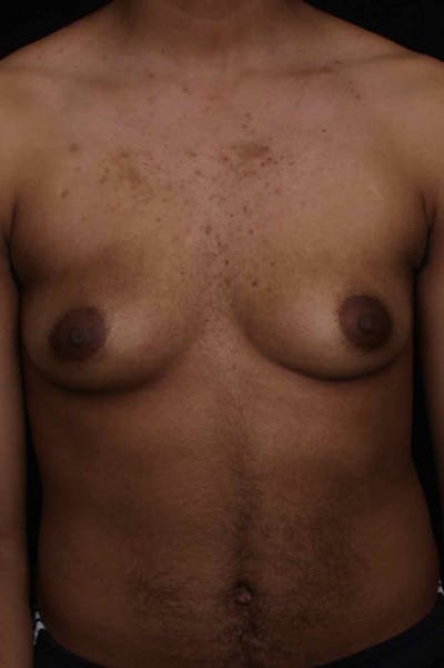 FTM Top Surgery Before & After Gallery - Patient 169056 - Image 1
