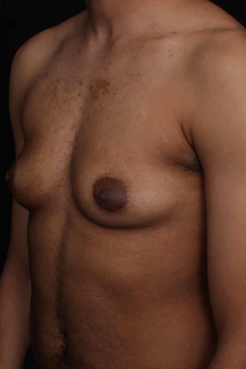 FTM Top Surgery Before & After Gallery - Patient 169056 - Image 3