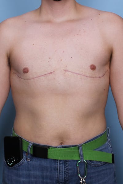 FTM Top Surgery Before & After Gallery - Patient 456830 - Image 2