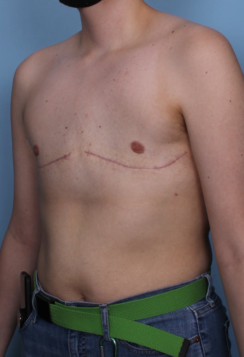 FTM Top Surgery Before & After Gallery - Patient 456830 - Image 4