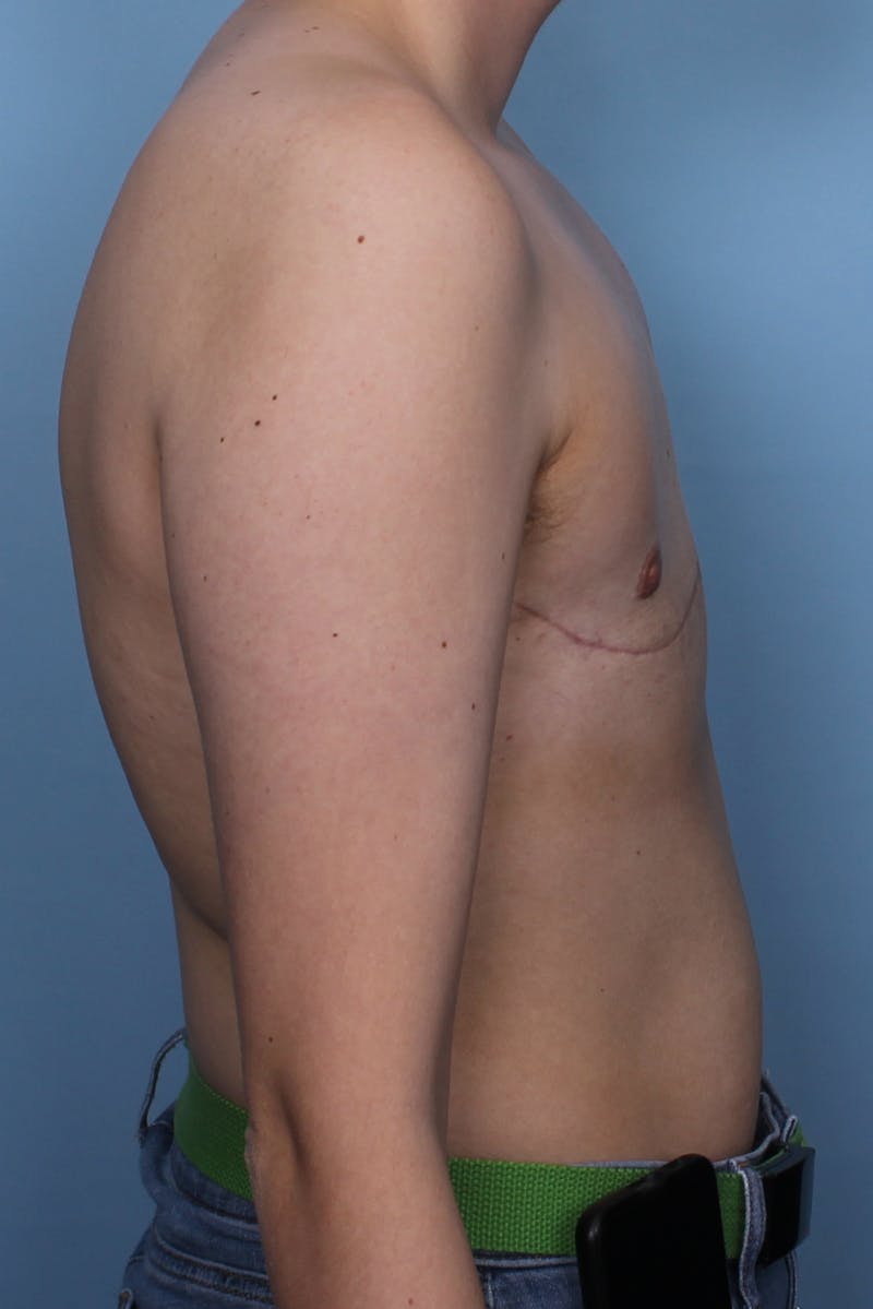FTM Top Surgery Before & After Gallery - Patient 456830 - Image 6