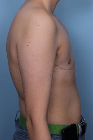 FTM Top Surgery Before & After Gallery - Patient 456830 - Image 6