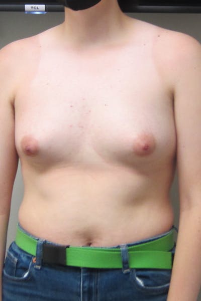 FTM Top Surgery Before & After Gallery - Patient 456830 - Image 1