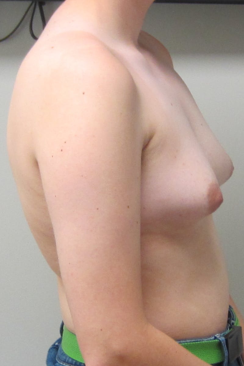 FTM Top Surgery Before & After Gallery - Patient 456830 - Image 5