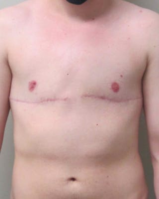FTM Top Surgery Before & After Gallery - Patient 331837 - Image 2