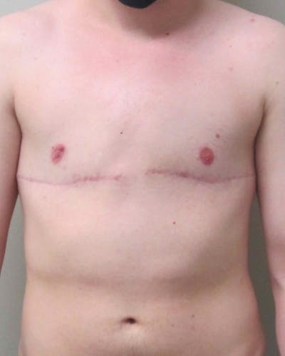 FTM Top Surgery Before & After Gallery - Patient 331837 - Image 2