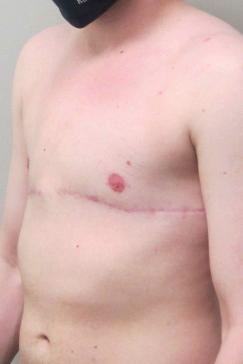 FTM Top Surgery Before & After Gallery - Patient 331837 - Image 4