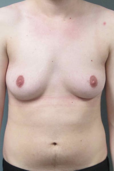 FTM Top Surgery Before & After Gallery - Patient 331837 - Image 1