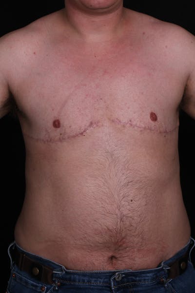 FTM Top Surgery Before & After Gallery - Patient 130833 - Image 2