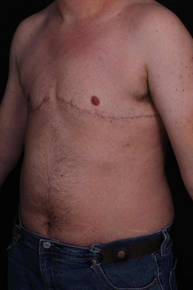 FTM Top Surgery Before & After Gallery - Patient 130833 - Image 4