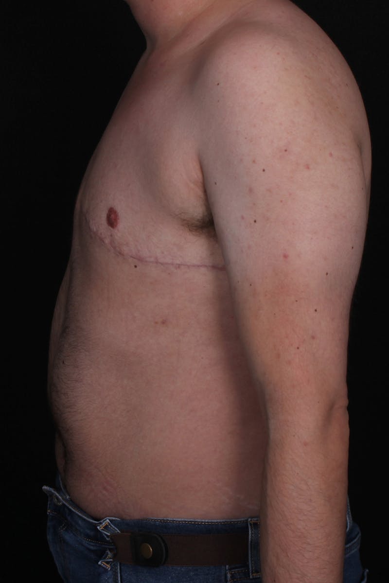 FTM Top Surgery Before & After Gallery - Patient 130833 - Image 6