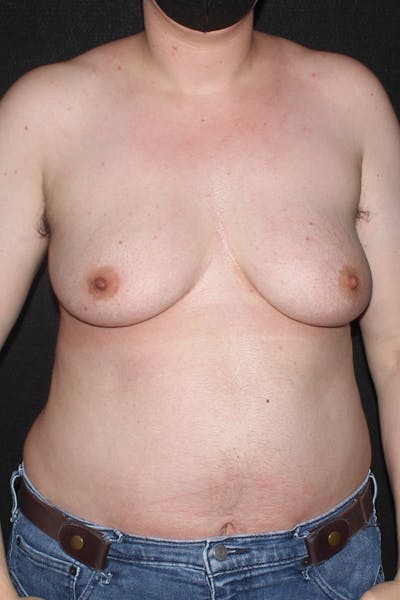 FTM Top Surgery Before & After Gallery - Patient 130833 - Image 1
