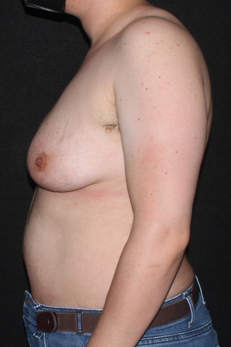 FTM Top Surgery Before & After Gallery - Patient 130833 - Image 5