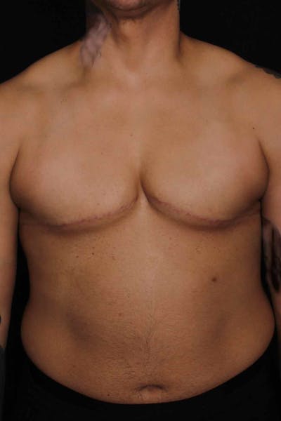 FTM Top Surgery Before & After Gallery - Patient 133639 - Image 2