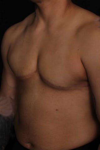 FTM Top Surgery Before & After Gallery - Patient 133639 - Image 6