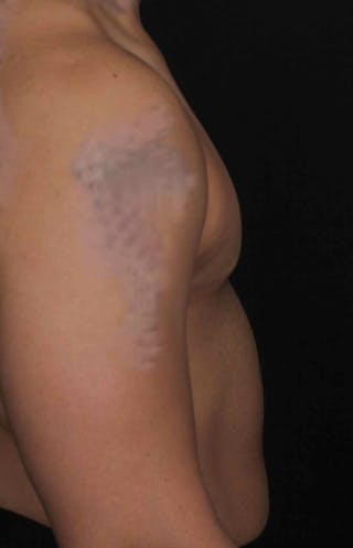 FTM Top Surgery Before & After Gallery - Patient 133639 - Image 8