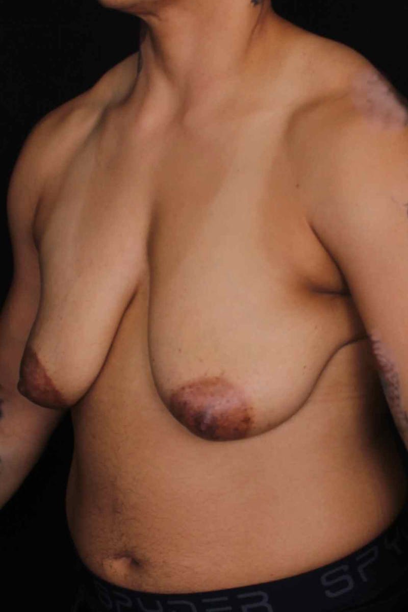 FTM Top Surgery Before & After Gallery - Patient 133639 - Image 5