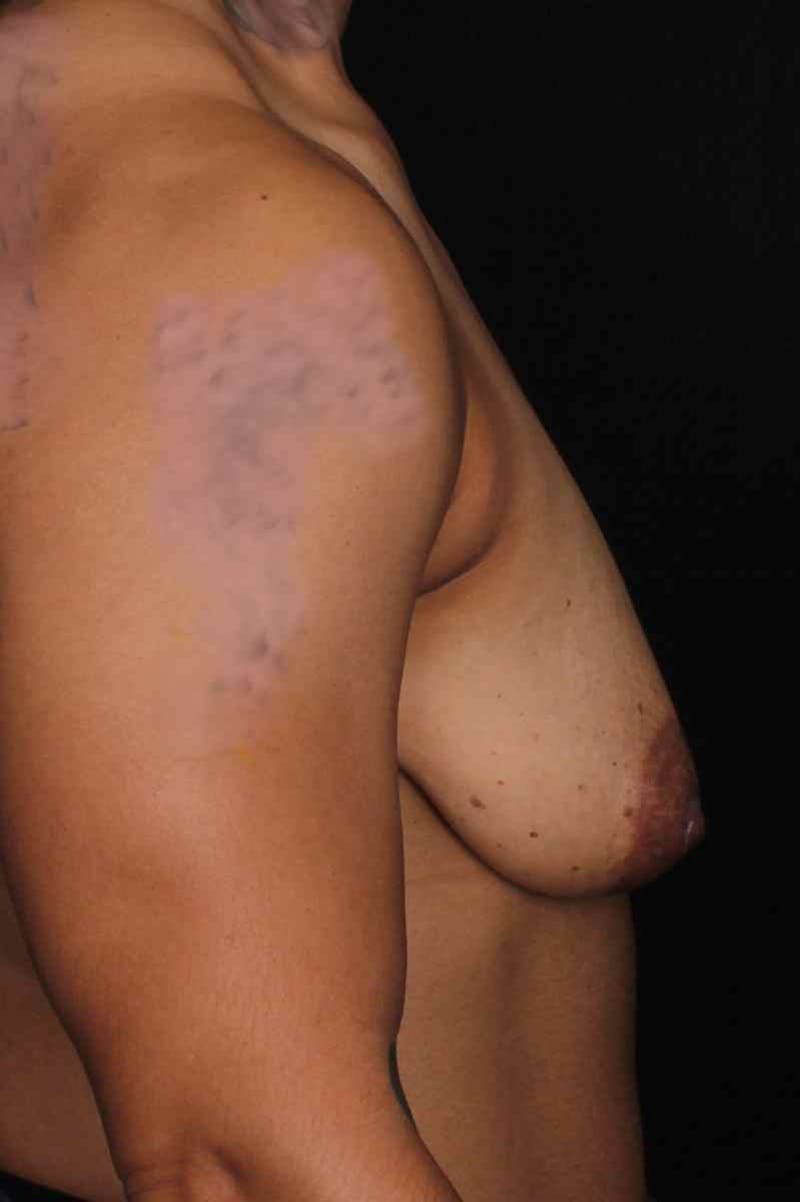 FTM Top Surgery Before & After Gallery - Patient 133639 - Image 5