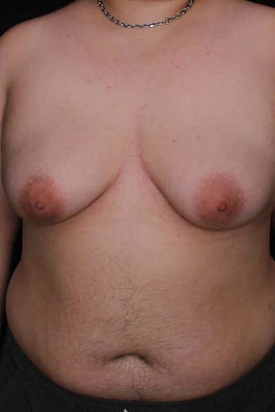 FTM Top Surgery Before & After Gallery - Patient 388651 - Image 1