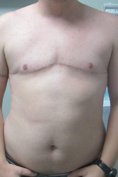 FTM Top Surgery Before & After Gallery - Patient 240505 - Image 2