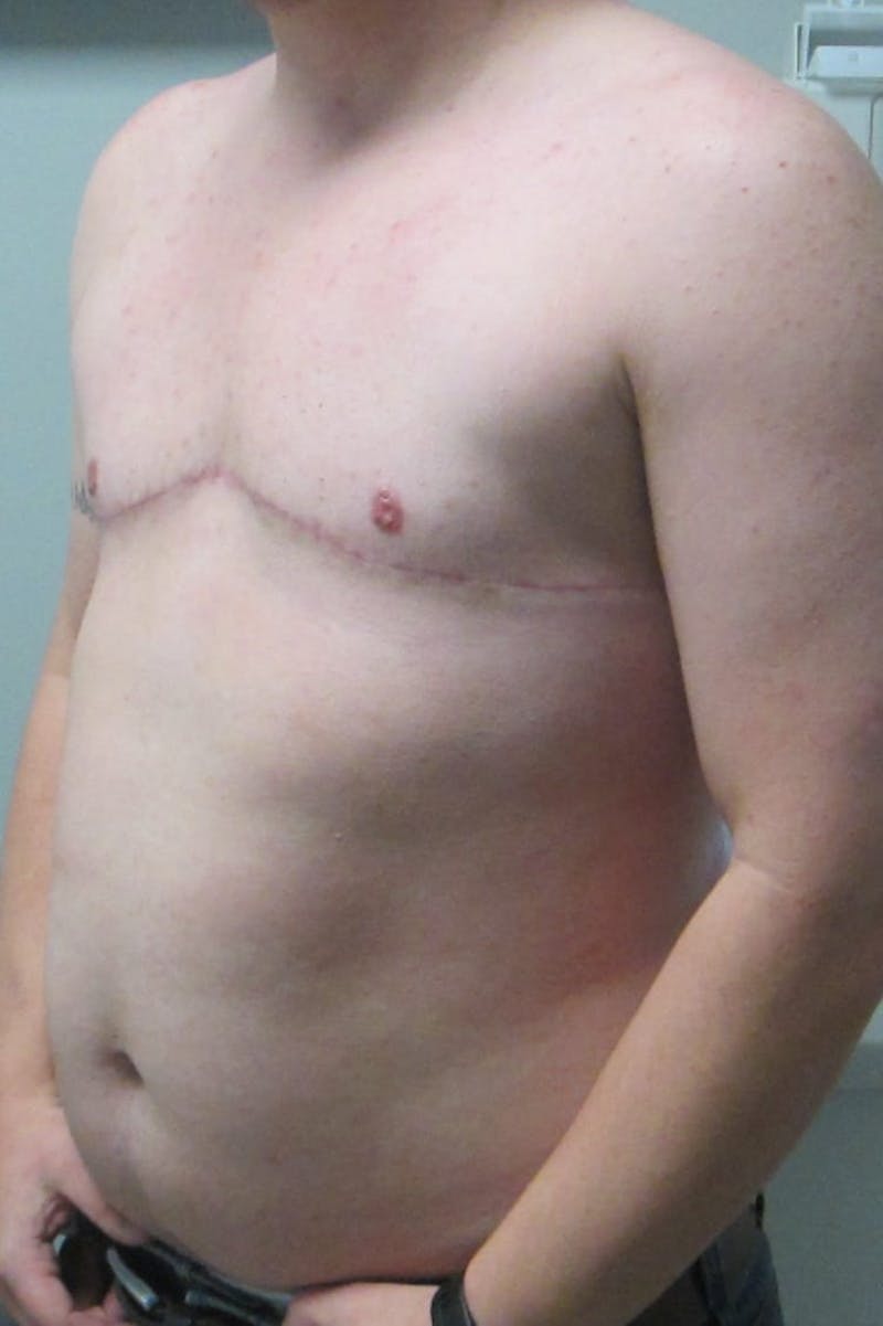 FTM Top Surgery Before & After Gallery - Patient 240505 - Image 4