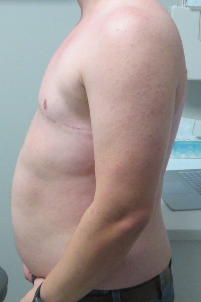 FTM Top Surgery Before & After Gallery - Patient 240505 - Image 6