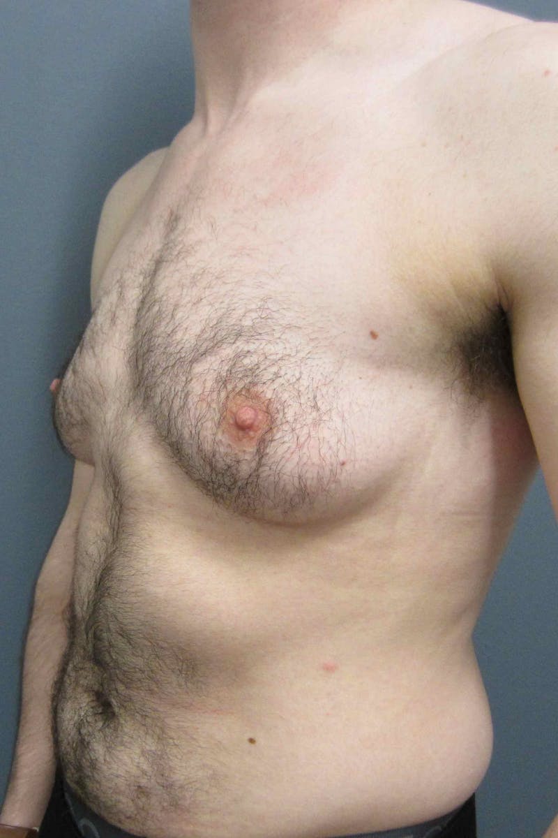 FTM Top Surgery Before & After Gallery - Patient 165364 - Image 5