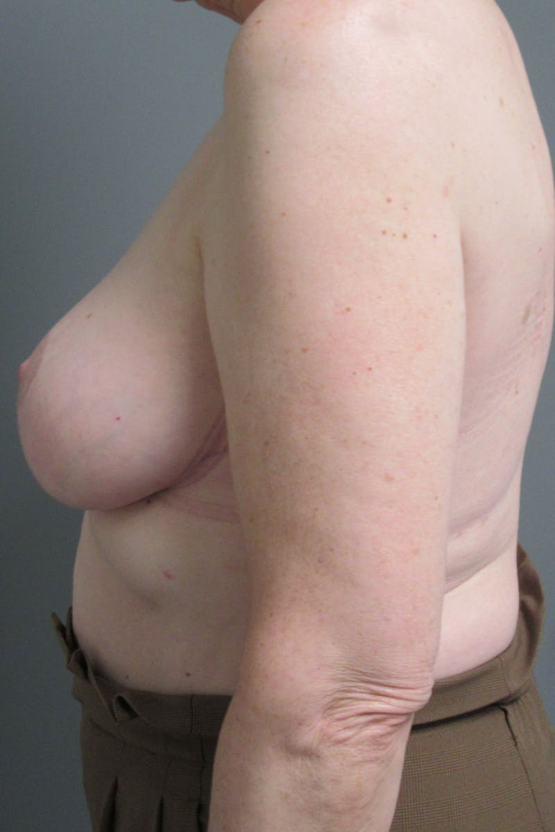Breast Reduction Before & After Gallery - Patient 173594 - Image 6