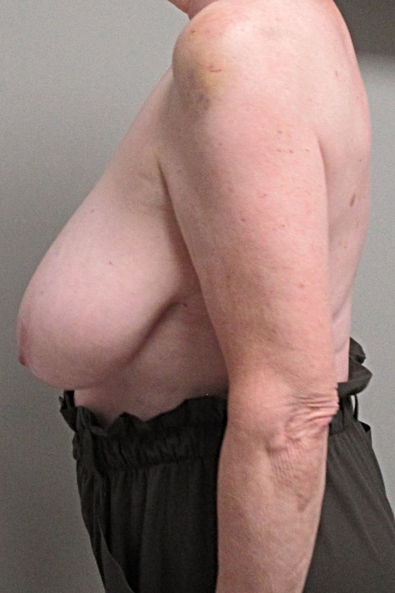 Breast Reduction Before & After Gallery - Patient 173594 - Image 5