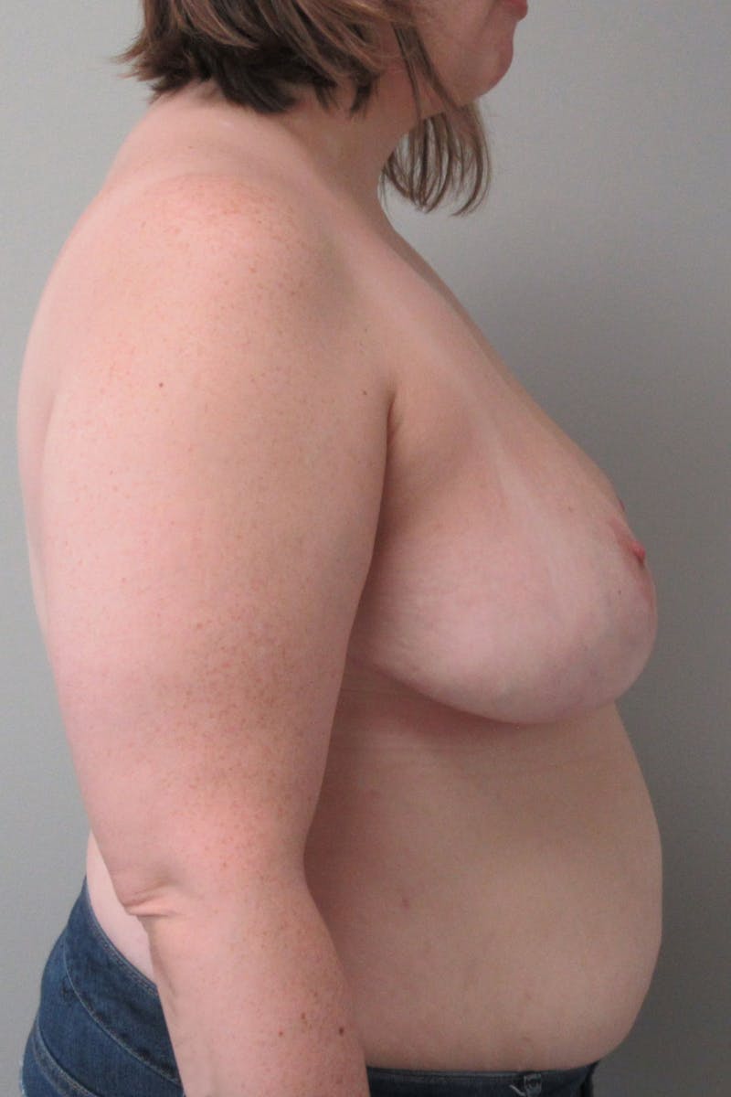 Breast Reduction Before & After Gallery - Patient 730411 - Image 6