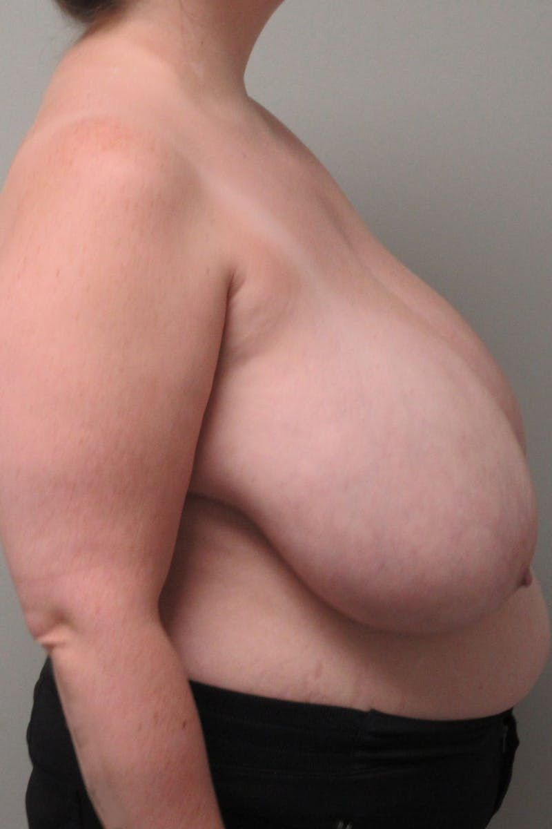 Breast Reduction Before & After Gallery - Patient 730411 - Image 5