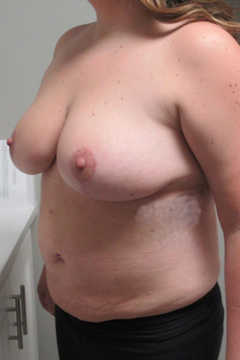 Breast Reduction Before & After Gallery - Patient 242381 - Image 4