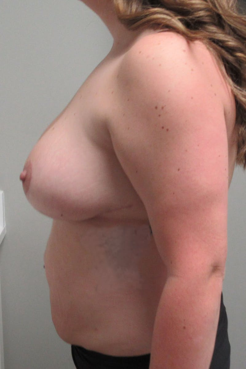 Breast Reduction Before & After Gallery - Patient 242381 - Image 6
