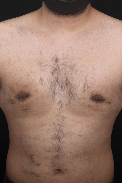 Gynecomastia Before & After Gallery - Patient 107303 - Image 2