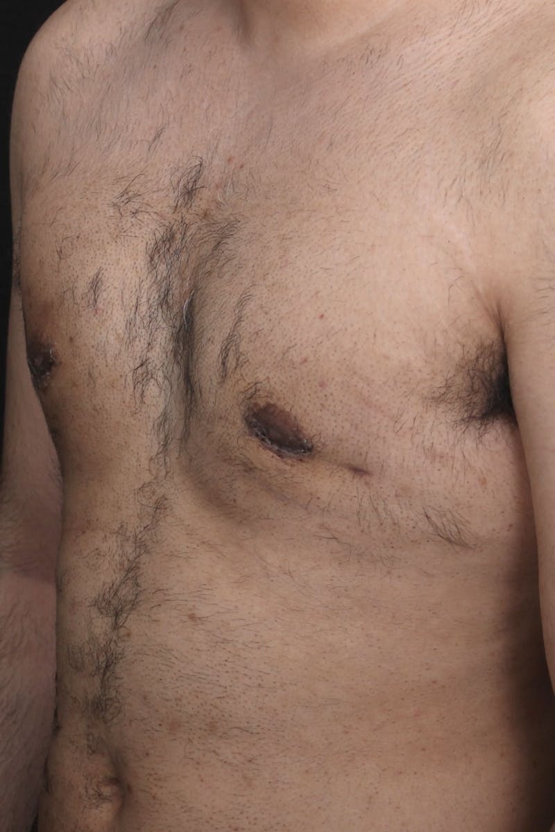 Gynecomastia Before & After Gallery - Patient 107303 - Image 4