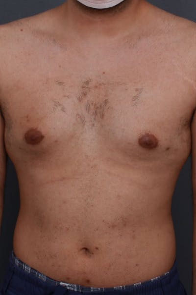 Gynecomastia Before & After Gallery - Patient 107303 - Image 1