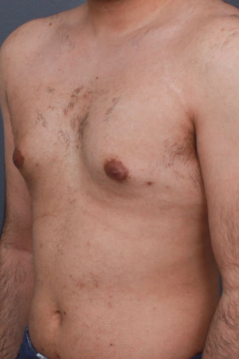 Gynecomastia Before & After Gallery - Patient 107303 - Image 3
