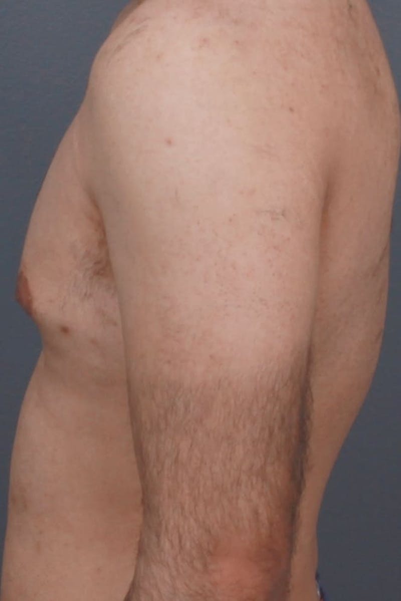 Gynecomastia Before & After Gallery - Patient 107303 - Image 5