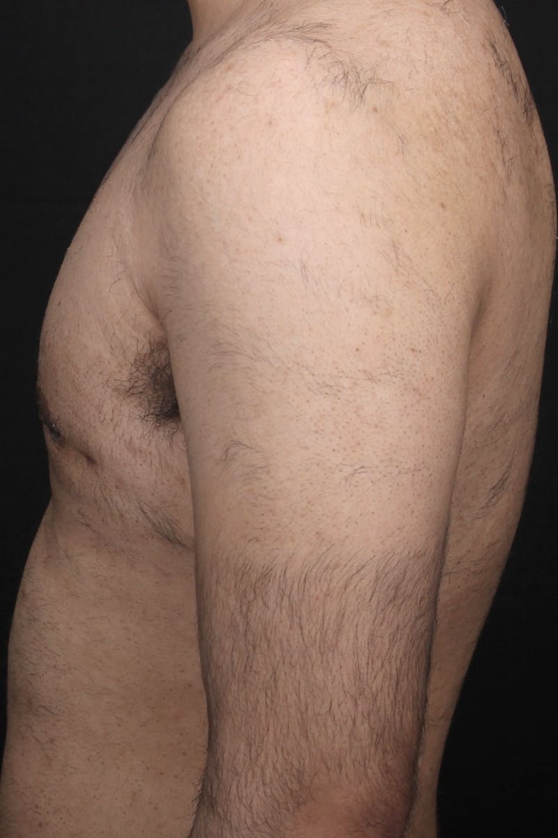 Gynecomastia Before & After Gallery - Patient 107303 - Image 6