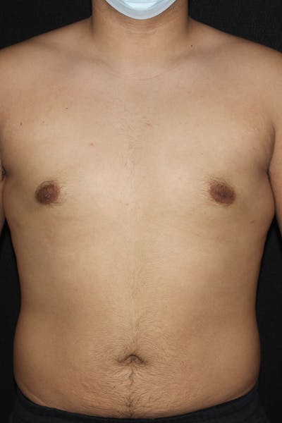 Gynecomastia Before & After Gallery - Patient 109285 - Image 2