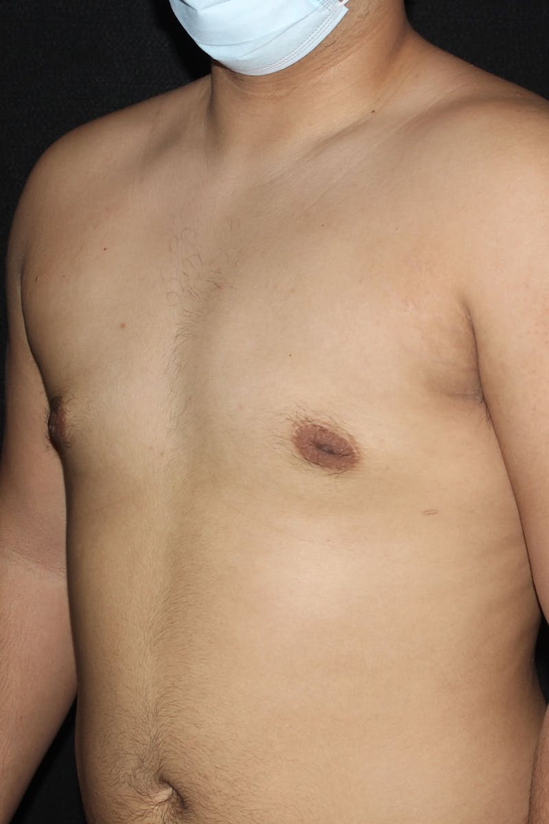 Gynecomastia Before & After Gallery - Patient 109285 - Image 4