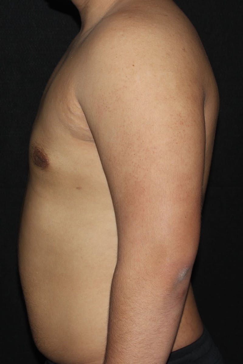 Gynecomastia Before & After Gallery - Patient 109285 - Image 6