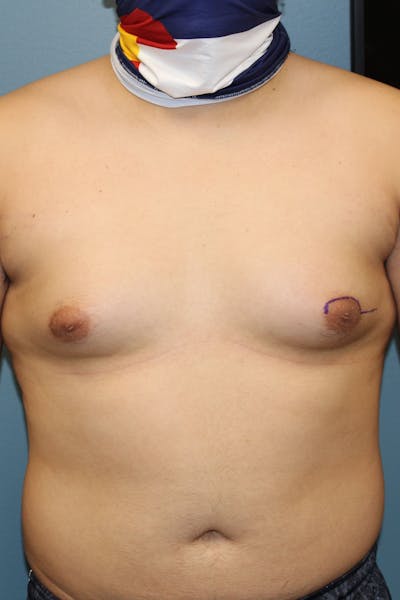 Gynecomastia Before & After Gallery - Patient 109285 - Image 1